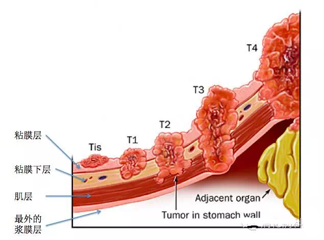 随着肿瘤生长,会浸润粘膜下层,肌层,突破浆膜层以及发生淋巴结转移和