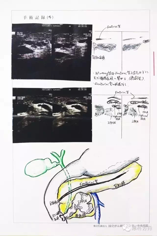 treitz韧带左侧分离,kocher切口,第16组淋巴结探查.