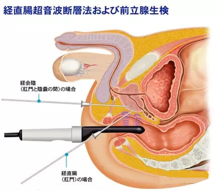 日本前列腺检查