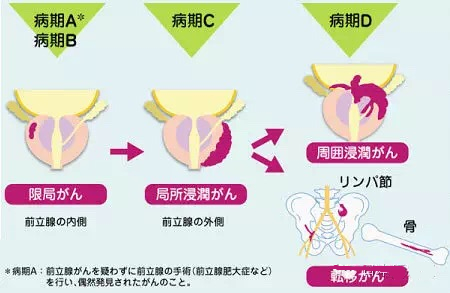 日本前列腺检查