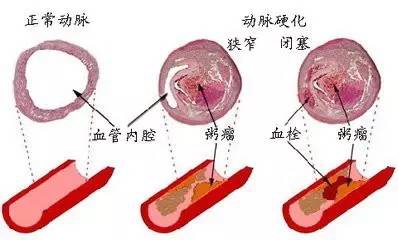 日本治疗冠状动脉粥样硬化