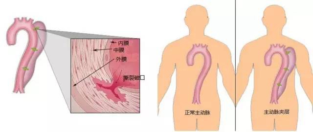 日本治疗冠状动脉粥样硬化