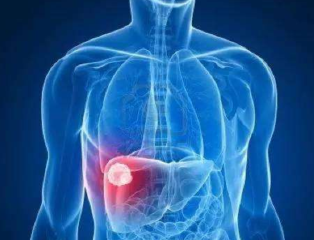 肝癌晚期要注意哪些并发症状发生