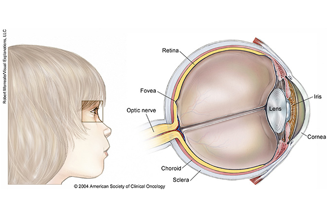 美国治疗视网膜母细胞瘤