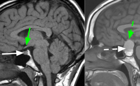 美国治疗垂体瘤