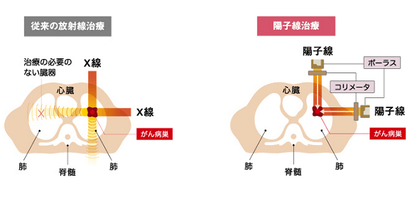 日本质子重离子治疗优势