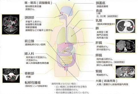 日本QST医院重离子治疗介绍