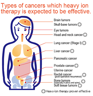 日本重离子治疗肿瘤效果