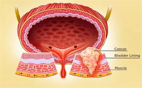 预防膀胱癌术后复发