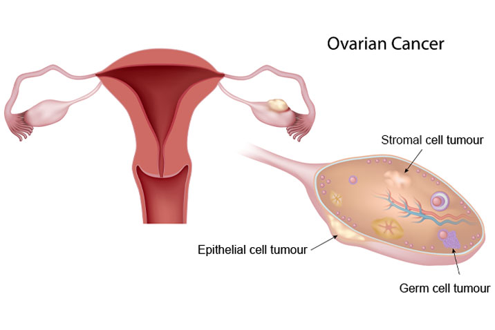 卵巢癌美国日本看病流程费用