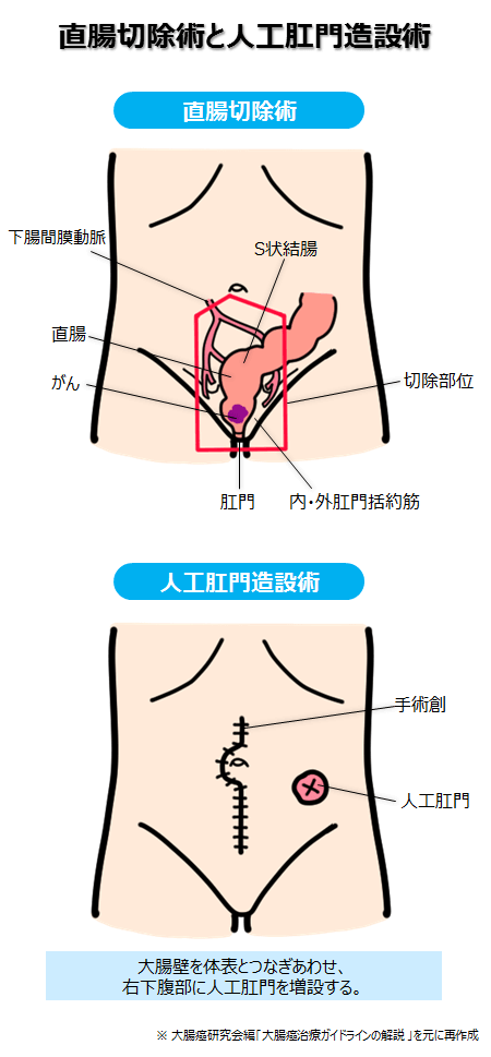 出国看病 日本医院结肠直肠癌常用治疗方法 厚朴方舟官方网站