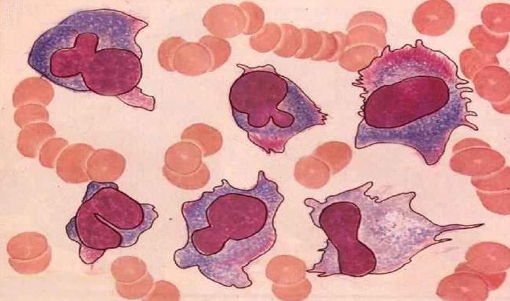骨癌细胞图片