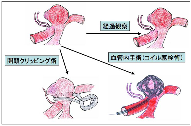 日本杉田动脉瘤夹图片