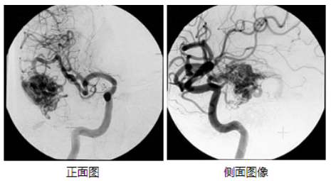 脑动静脉畸形治疗
