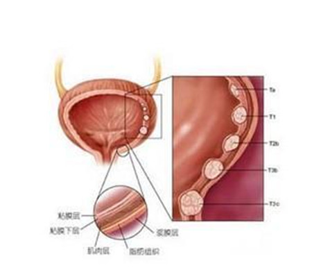 日本治疗膀胱癌