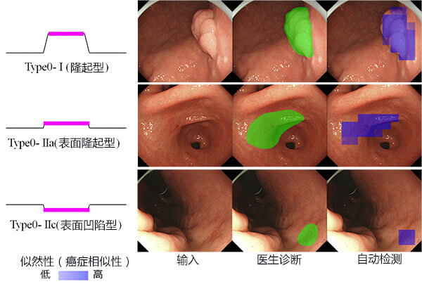 日本研究出早期胃癌检测方法