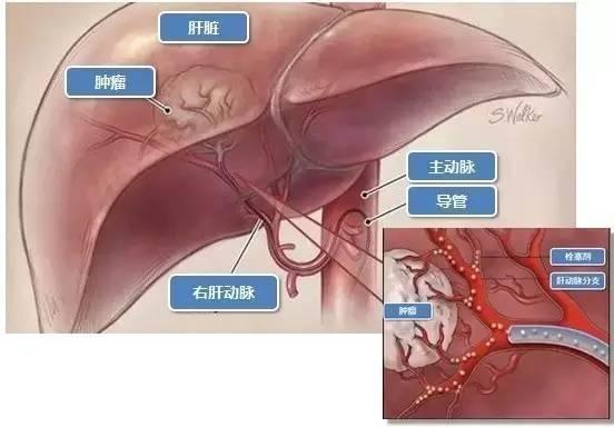 日本治疗肝癌