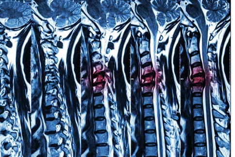 印第安纳大学的研究人员确定了改善脊髓损伤后的功能恢复的潜在目标
