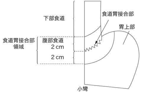 食管胃交界癌