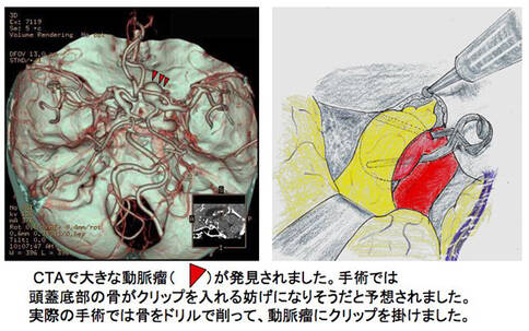 脑血管瘤治疗方法