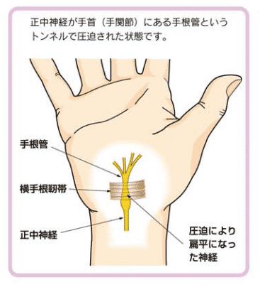 什么是腕管综合征?日本如何治疗腕管综合征?