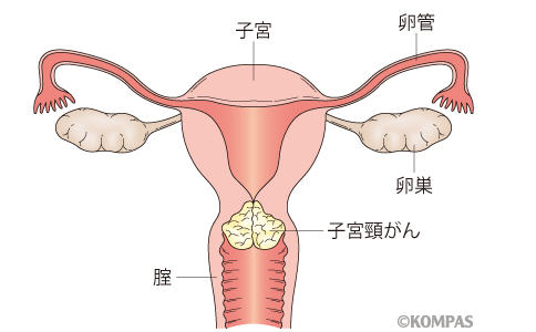 日本宫颈癌医院