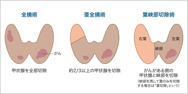 日本甲状腺癌治疗方法