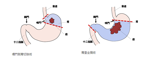 日本胃癌治疗医院