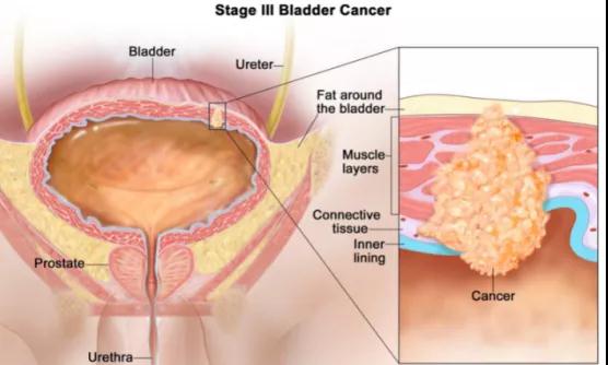 膀胱癌手术后能活几年，国外膀胱癌手术治疗